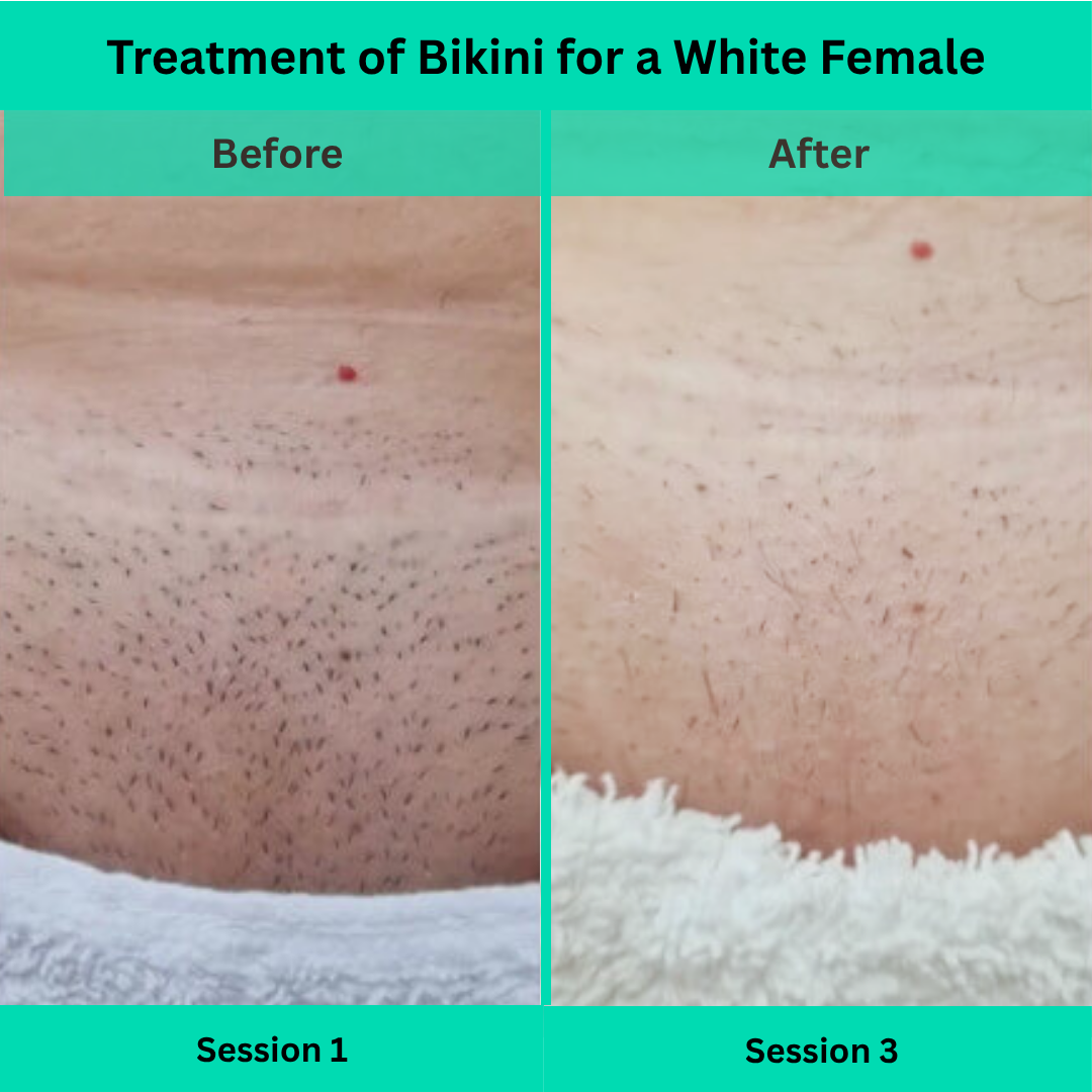 Before and After picture of Laser Hair Removal Treatment of Bikini for a White Female